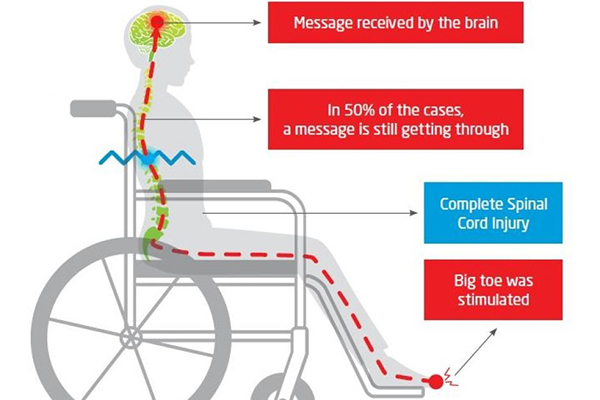 Article image for Aussie discovery gives hope for paraplegics