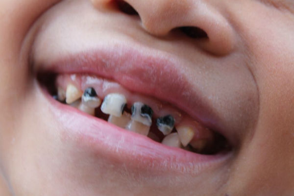 Too many children having a brush with tooth decay