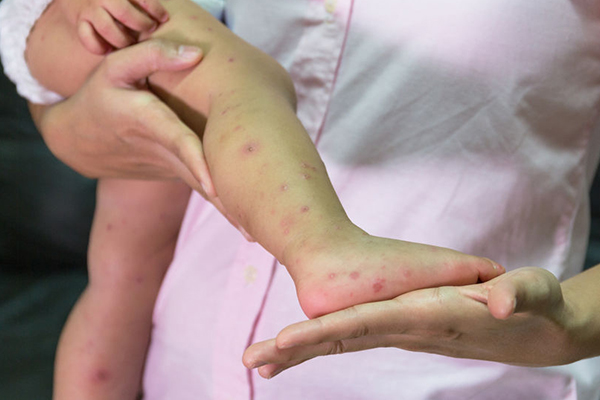 Article image for Health warning issued after third person diagnosed with measles