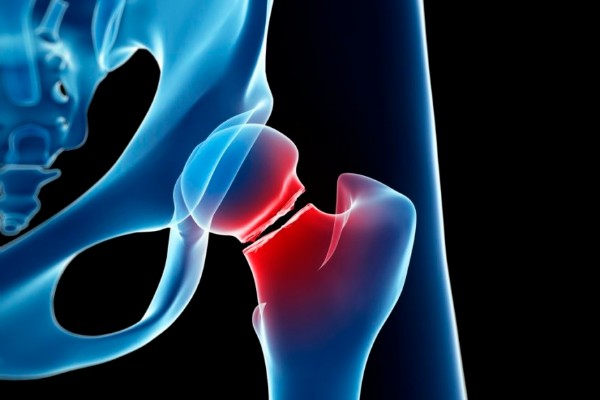Exercising science to guard against bone fractures