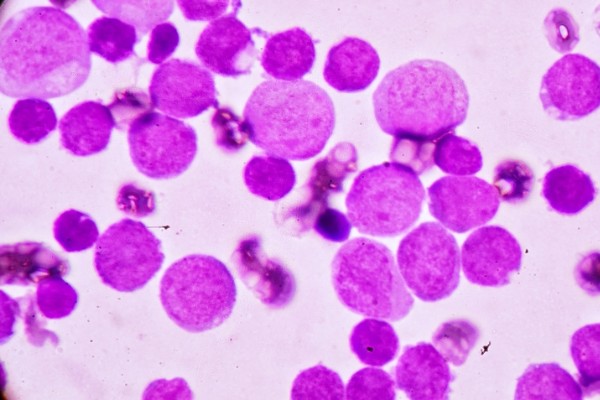 Blood cancer, underestimated and under reported