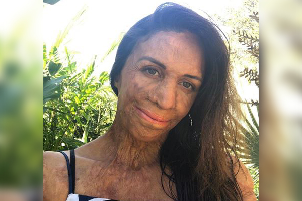 Article image for No bitter pills: Turia Pitt’s dose of Kyndness for those in need