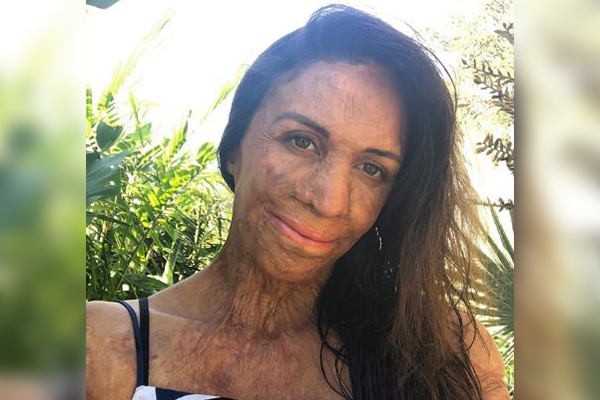 Turia Pitt launches heartwarming campaign to help bushfire-affected businesses