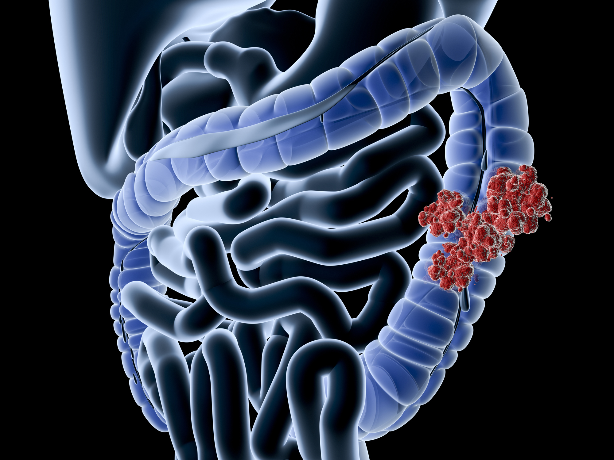 Article image for The ‘astounding’ bowel cancer statistic