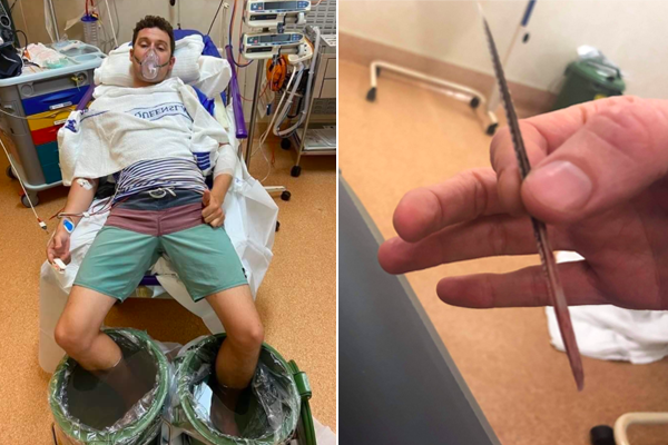 Article image for Teacher gets stingray barb lodged in his leg