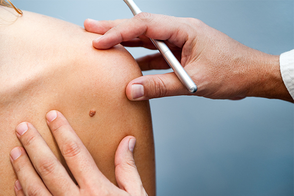 3D skin scans hold hope of early melanoma detection