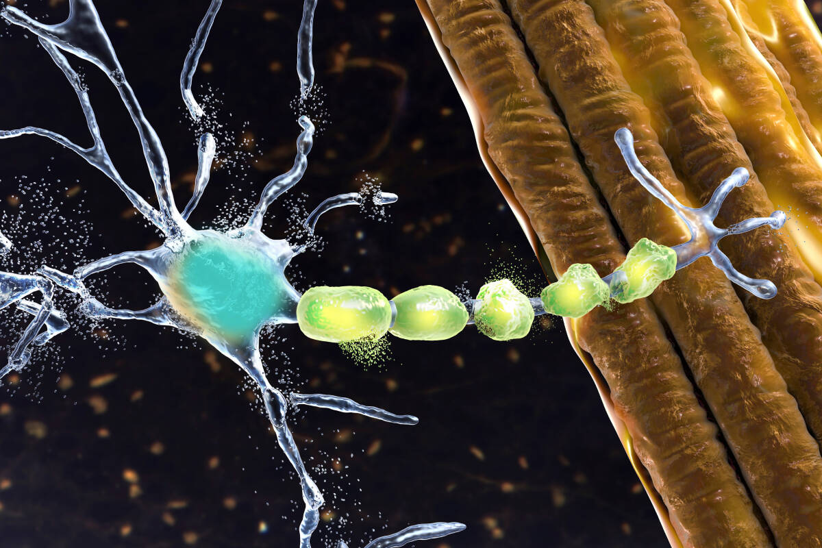 Article image for Investment of close to $70m has ‘changed the landscape’ of MND research