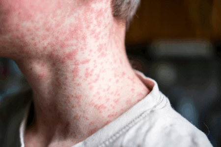 Why 1.7 million Australians are completely defenceless against a terrifying virus surge